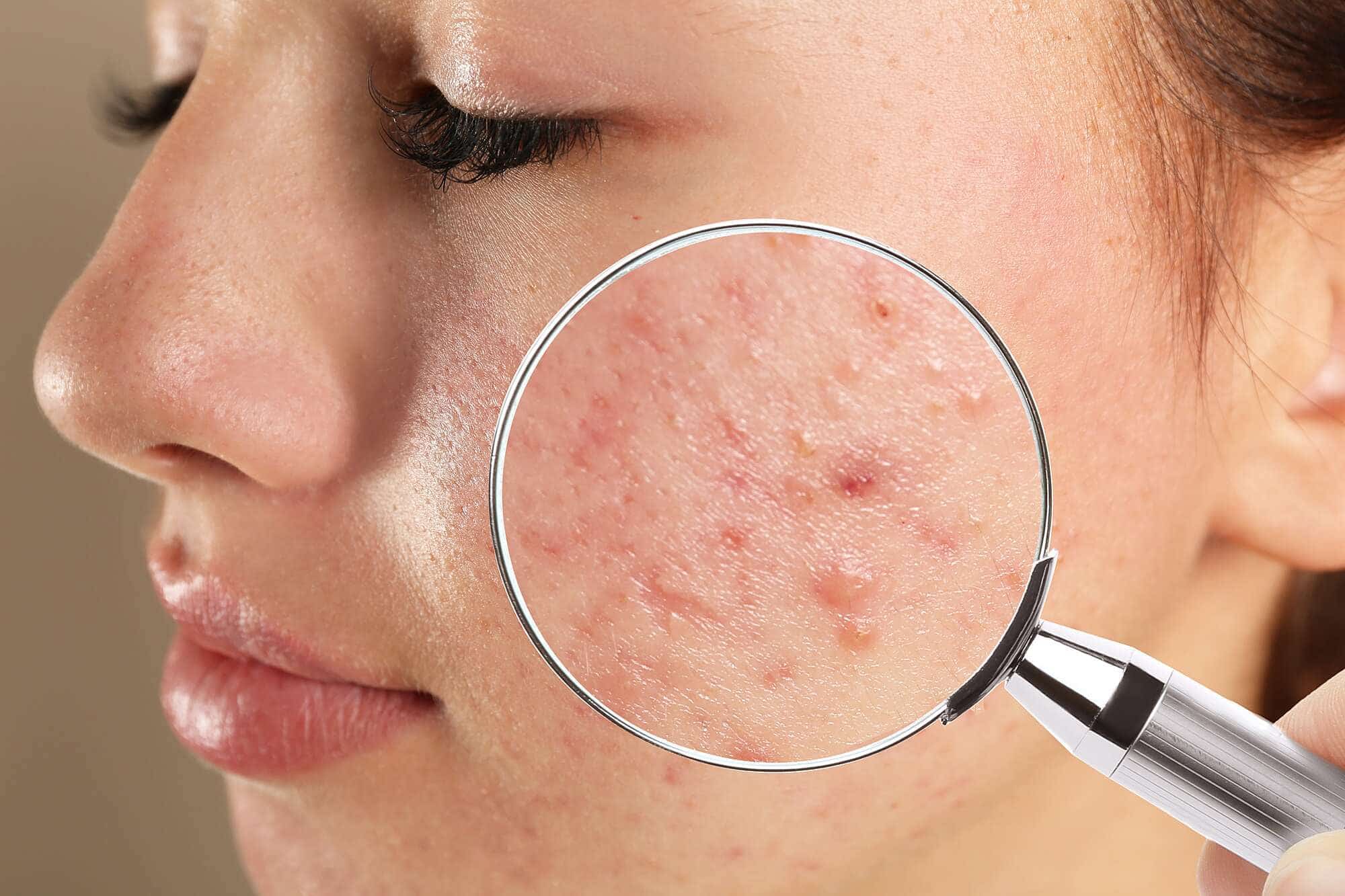 Micro scope on face for pimples