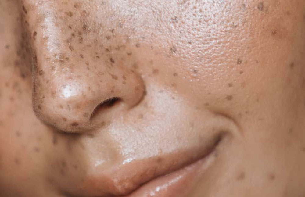 pigmentation on face