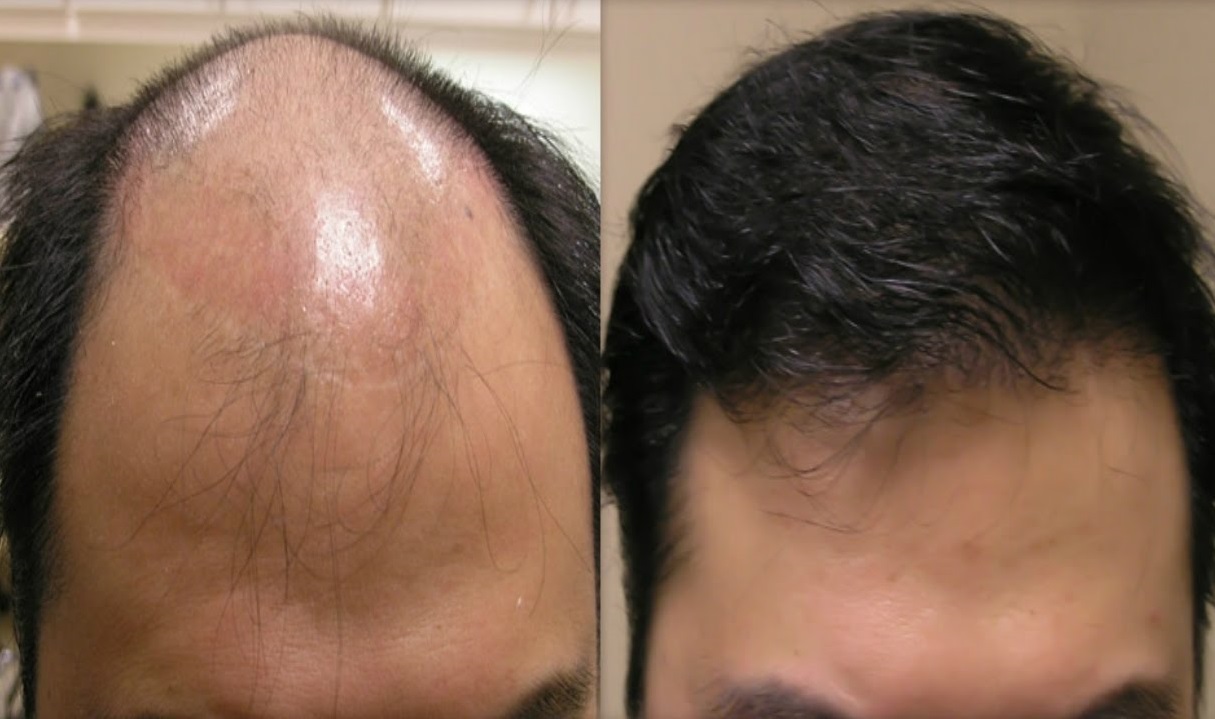 Hair loss patient with result