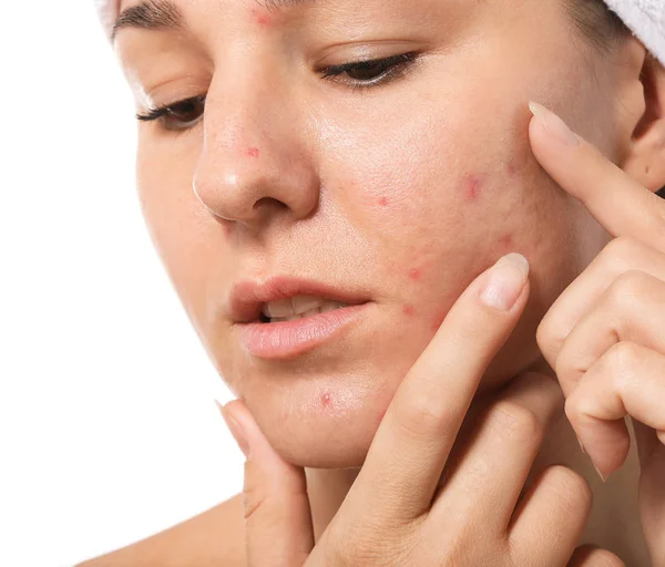 Showing face pimples lady