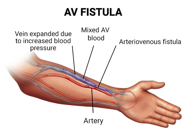 Av Fistula Surgery hand